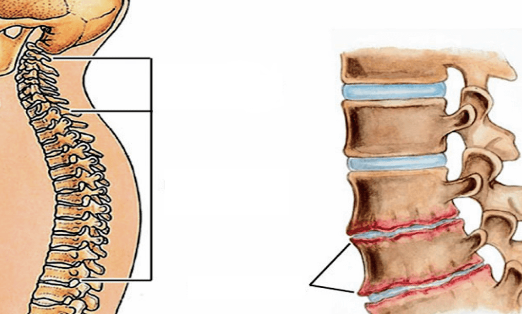 How does the spine look osteochondrosis