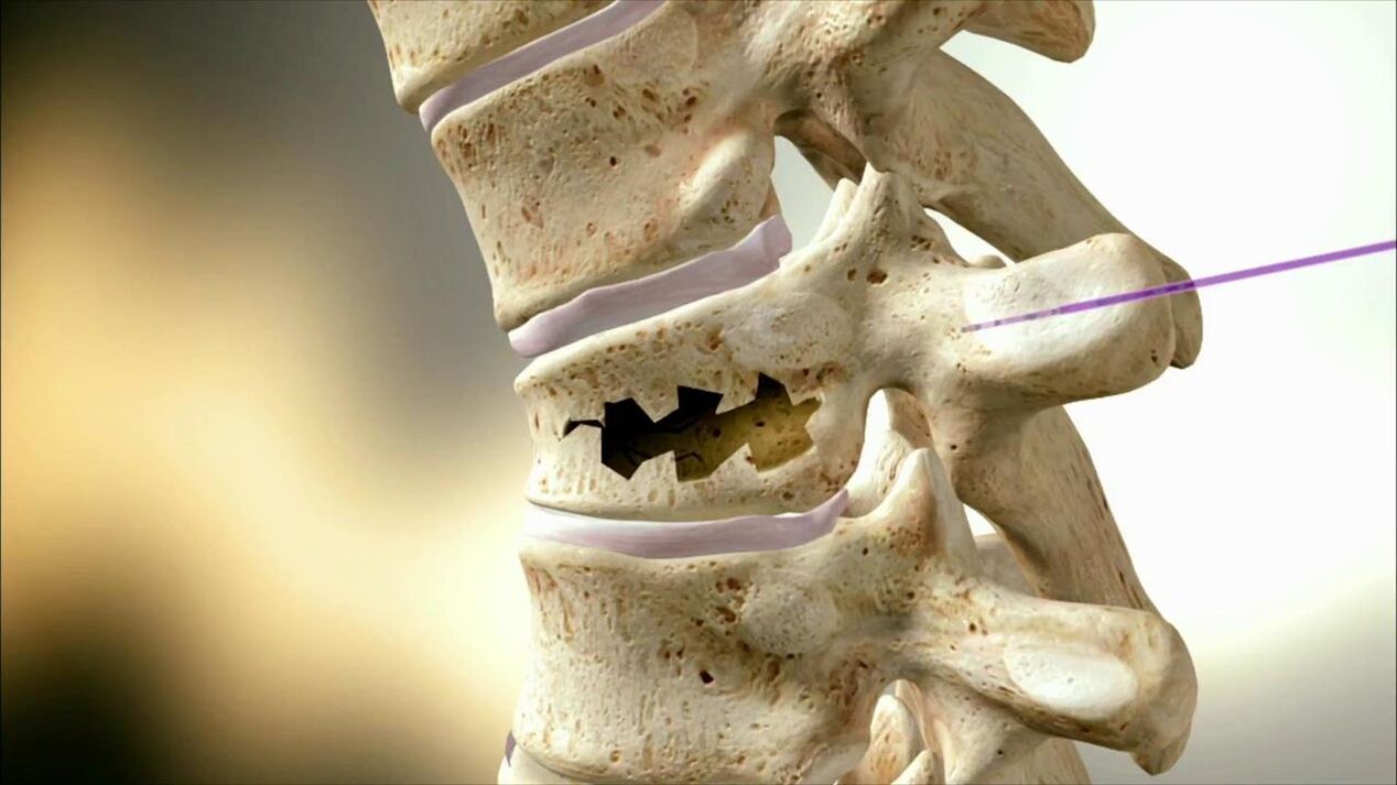 Injured spine