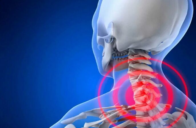 The cervical spine osteochondrosis