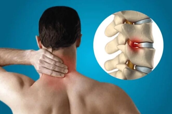 The spine osteochondrosis