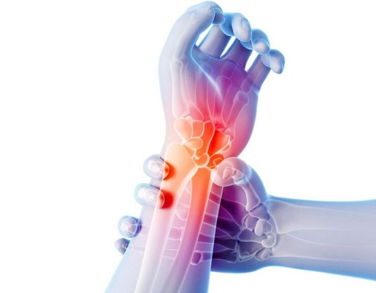 Arthrosis of the joints is accompanied by pain and requires complex treatment