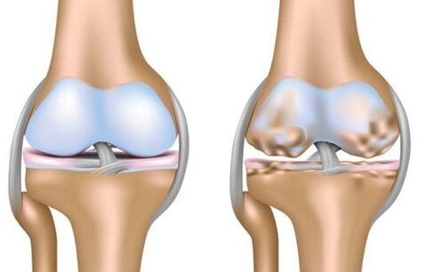 healthy joint and the destruction of the knee joint due to arthrosis