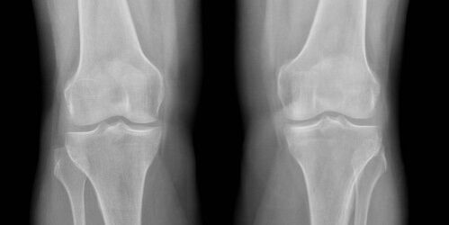 knee arthrosis on X-ray