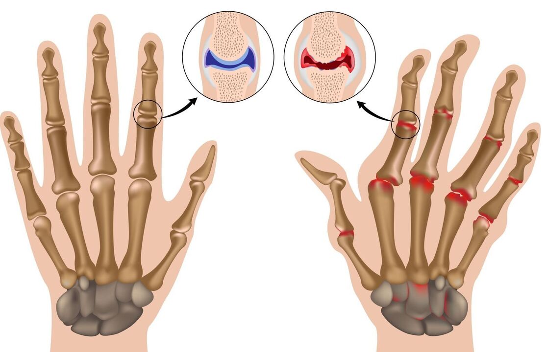 rheumatoid arthritis